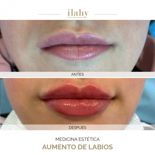 Aumento de labios